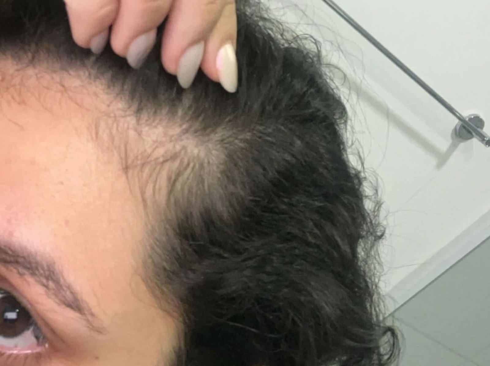 Antes do Tratamento 1